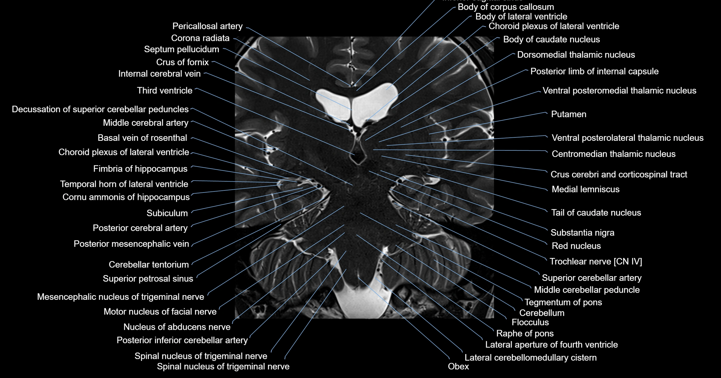 MRI brainstem & basal ganglia anatomy labelled 3T MRI images -img-00001-00024.webp